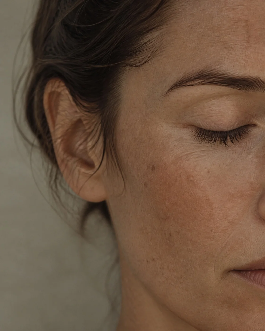 Cheek and temple under diffuse light, showing freckling and uneven pigment.